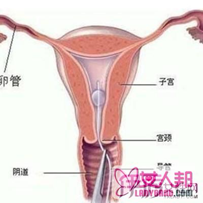 子宫下垂是怎样的呢 详细介绍子宫下垂的治疗方法