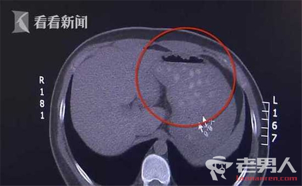 >男生贪杯奶茶致胆囊炎 胃内查出数十粒珍珠