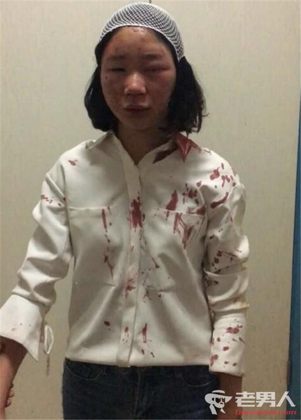华师女生自曝昆明街头被打 满脸是血被缝6针