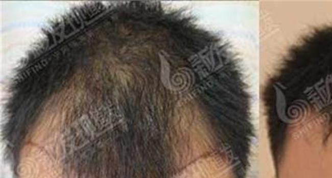 【毛发移植新生专业】专业的毛发移植术VIC