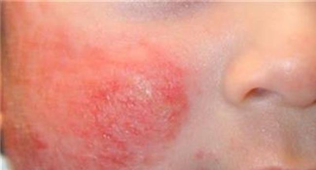 >【湿疹和热疹的区别图片】红斑狼疮和湿疹的区别