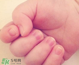 宝宝指甲凹凸不平是什么原因？宝宝指甲凹凸不平正常吗？