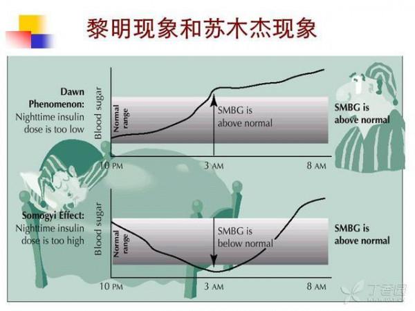 黎明现象怎么处理 苏木杰现象、黎明现象及处理