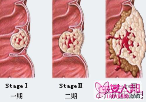 肠癌晚期能活多久呢  怎么延长生命的期限