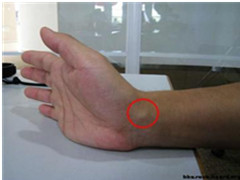 手腕扭伤怎么办 手腕扭伤症状表现