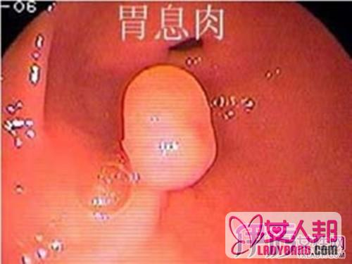 >胃息肉有什么特征呢 最全的胃息肉知识详细介绍