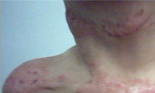 烫伤疤痕增生怎么有效治疗?