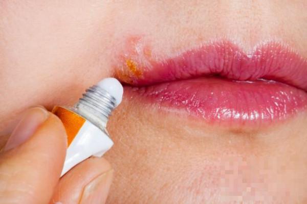 嘴角起泡抹香油管用吗  是否还有其他的解决方法