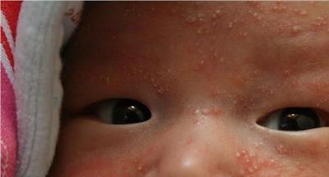【婴儿湿疹症状】婴儿湿疹的病因 不同类型婴儿湿疹的症状