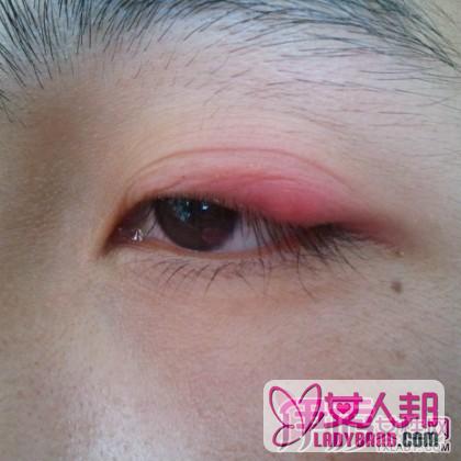 眼皮红肿痛是怎么回事 眼睛过度劳累易诱发红肿