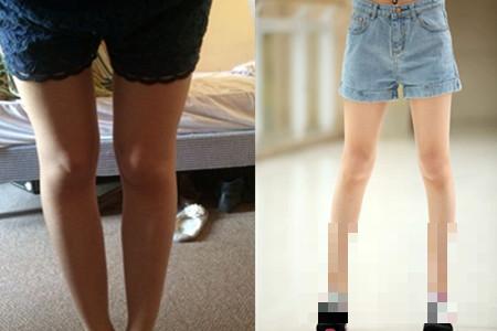 >O型腿表现有哪些   该怎么样矫正