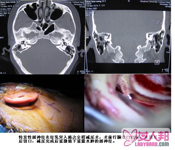 周围性面瘫的手术治疗