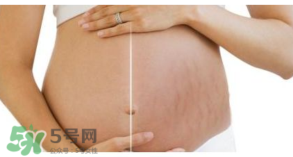 妊娠纹到底是怎么样形成的？妊娠纹形成的原因是什么