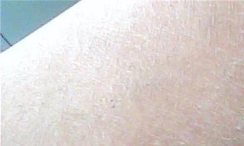 皮肤干燥缺什么维生素 皮肤为什么会干燥 皮肤干燥缺什么维生素