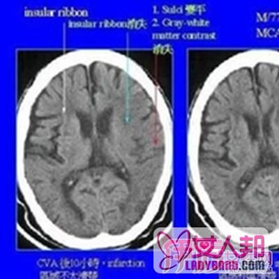 婴儿脑损伤的早期表现   帮你第一时间发现与治疗