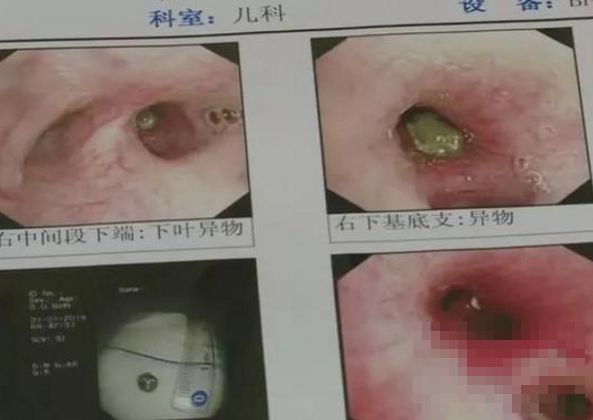 "珍珠"奶茶引爆奶茶迷 吃入体内半年不化 这个孩子被害的好惨