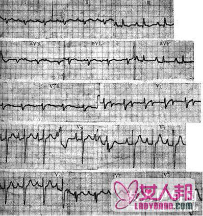 病毒性心肌炎发病原因