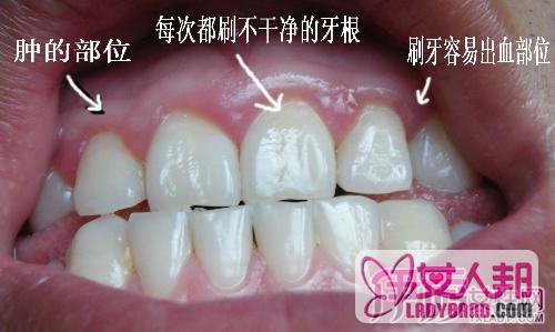 >牙龈萎缩图片介绍 几个妙招缓解牙龈问题