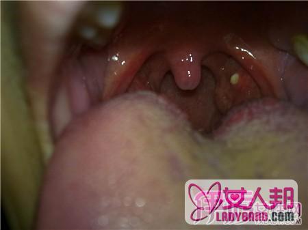 >舌根淋巴滤泡增生的临床表现有哪些？  4大症状引起病发
