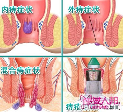 >教你如何判断痔疮 四点提前预防远离痔疮