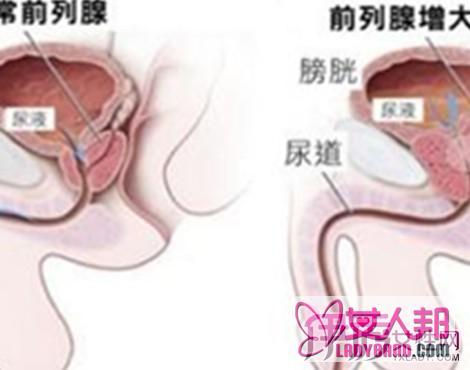 前列腺增大的治疗过程 该症状的3种治疗方法