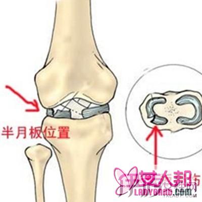 盘点什么半月板损伤修复术 了解半月板损伤的临床症状