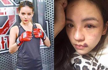 港姐刘燕妮被暴打后宣布退出演艺圈 漂亮脸蛋被打成猪头