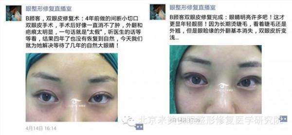 >王振军双眼皮修复5 2015年3月4日B顾客 双眼皮修复术后6个月恢复过程及效果展示