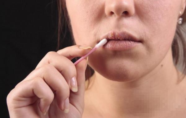 解析冬天烂嘴角是什么原因 让嘴唇更加健康的方法