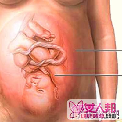 >子宫内膜增殖症是什么 揭秘其治疗原则