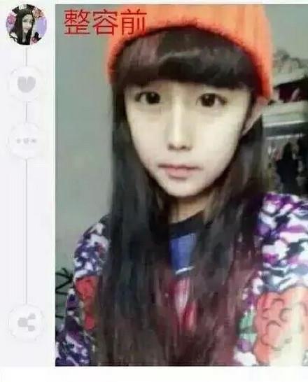 郑州15岁女孩李蒽熙整容前后对比照片