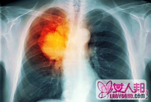 肺癌晚期能治好吗 了解其晚期转移症状刻不容缓！
