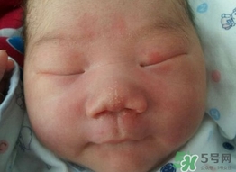 新生儿脸上长小白点是怎么回事?是什么原因?
