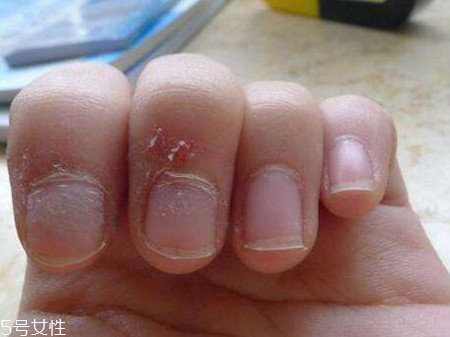 >手指起倒刺是什么原因 肌肤太干燥引起