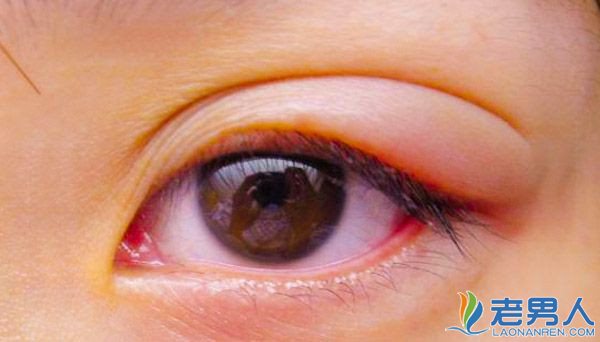 >眼睛长针眼有哪些症状 会不会相互传染