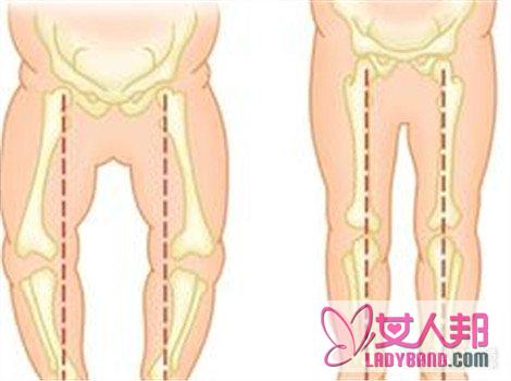 分析膝盖内翻怎么矫正 让你摆脱o型腿