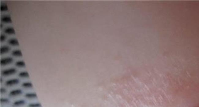 【湿疹快速消退方法】临床治疗皮肤湿疹的方法总共有多少种