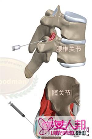 >封闭针有什么副作用 到底该不该打？