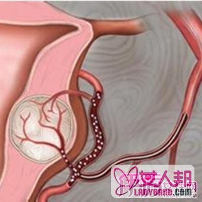 >女人子宫肌瘤图片展示 教你认清子宫肌瘤的临床表现
