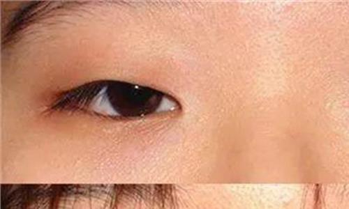 有内眦赘皮的双眼皮图 内眦赘皮的双眼皮怎么办 关于割双眼皮的常识