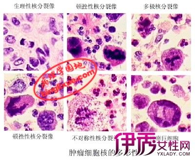 良性和恶性肿瘤的区别 教你妙招怎样区别