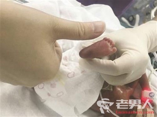 >南京巴掌宝宝出院 是国内最小胎龄早产儿