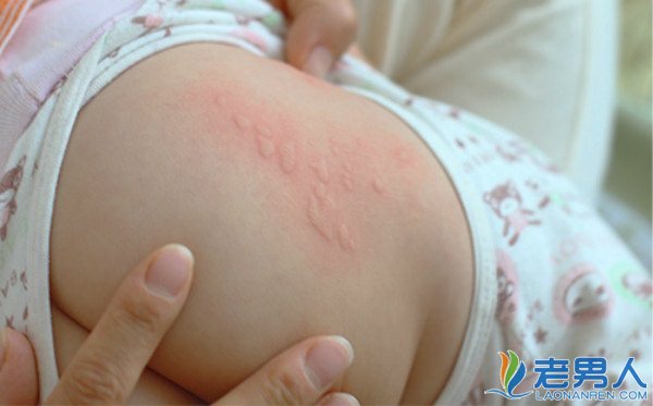 >新生儿患有荨麻疹应该怎么办 有什么治疗方法