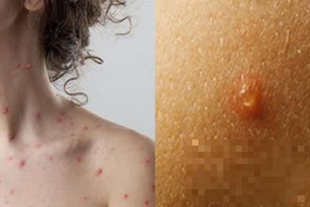 >大人感染水痘初期症状 你需要知道的健康小知识