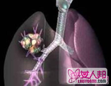 肺癌有传染吗  为你介绍肺癌的临床表现