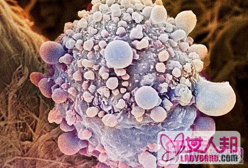 小细胞肺癌的发病原因是什么 以及相关疾病预防方法
