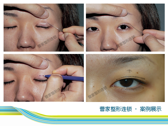 >李斌斌双眼皮太丑了 想割双眼皮 做了北京双眼皮医生的功课 分享给大