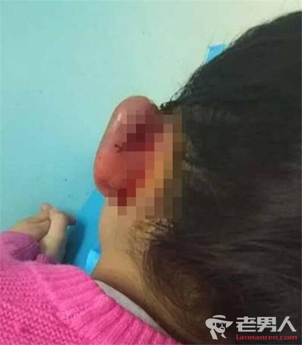 >女孩在幼儿园遭老师打伤左耳 涉事老师称孩子跌倒所致