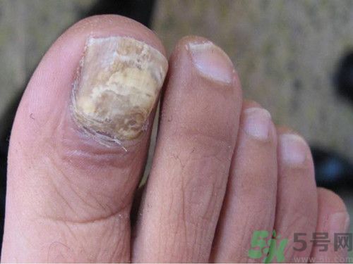 >灰指甲的危害有哪些?灰指甲的初期症状是什么