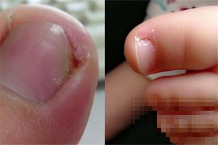 指甲病的种类  生活中常见的有哪些